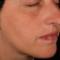 Woman's face profile showing uneven skin tone and texture