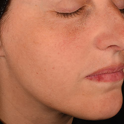 Woman's face profile showing more even skin tone and texture