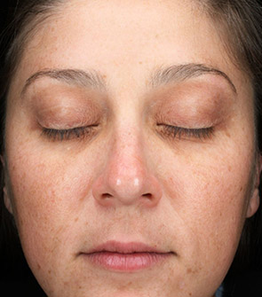 Woman's face with uneven skin tone and fine lines