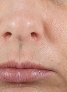 Woman's nose and mouth area with deep lines and visible pores